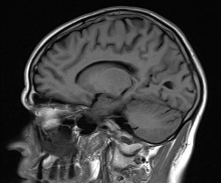 File:Cerebral venous thrombosis (Radiopaedia 71207-81504 Sagittal T1 16).jpg