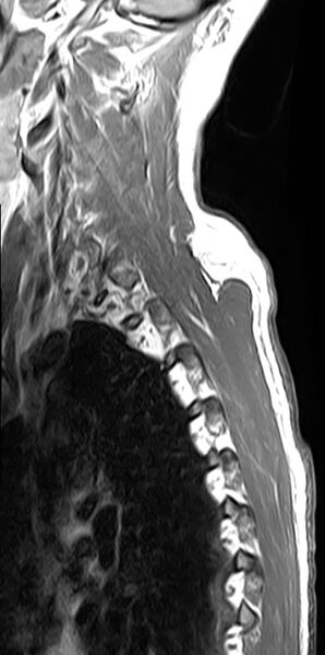 File:Cervical compressive myelopathy (Radiopaedia 71956-82411 Sagittal T1 C+ 1).jpg