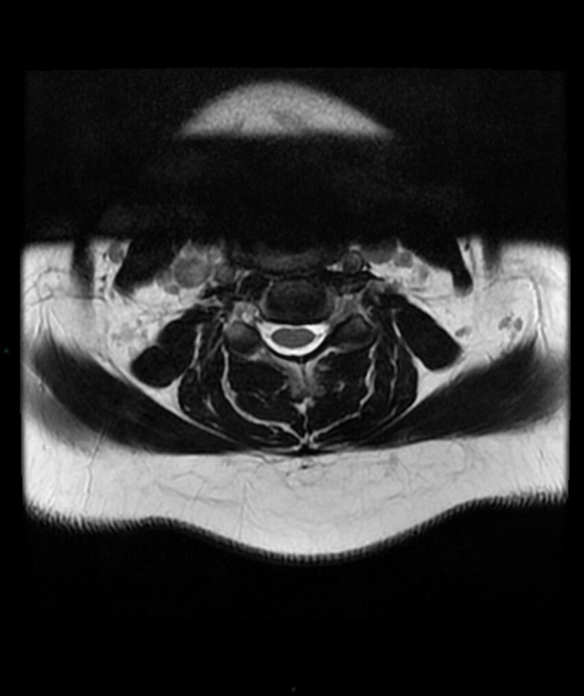 Cervical disc prolapse (Radiopaedia 80258-93598 Axial T2 25).jpg