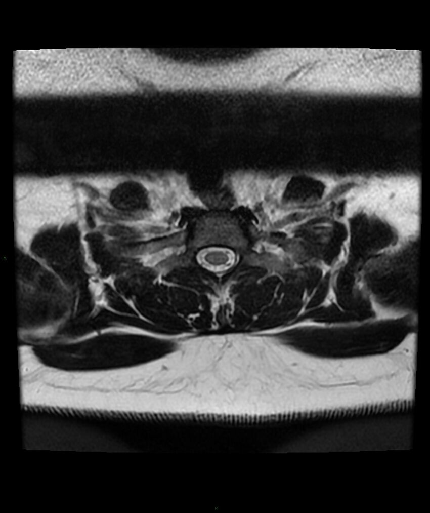 Cervical disc prolapse (Radiopaedia 80258-93598 Axial T2 78).jpg