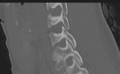Cervical disc replacement (Radiopaedia 37383-39205 Sagittal bone window 31).png