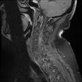 Cervical schwannoma (Radiopaedia 72399-82934 E 6).jpg