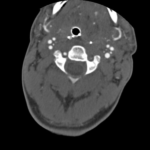 File:Cervical spine fractures with vertebral artery dissection (Radiopaedia 32135-33078 D 59).jpg