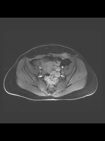 File:Cesarean section scar endometrioma (Radiopaedia 56569-63297 Axial T1 C+ fat sat 28).jpg