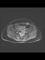 Cesarean section scar endometrioma (Radiopaedia 56569-63297 Axial T1 C+ fat sat 28).jpg
