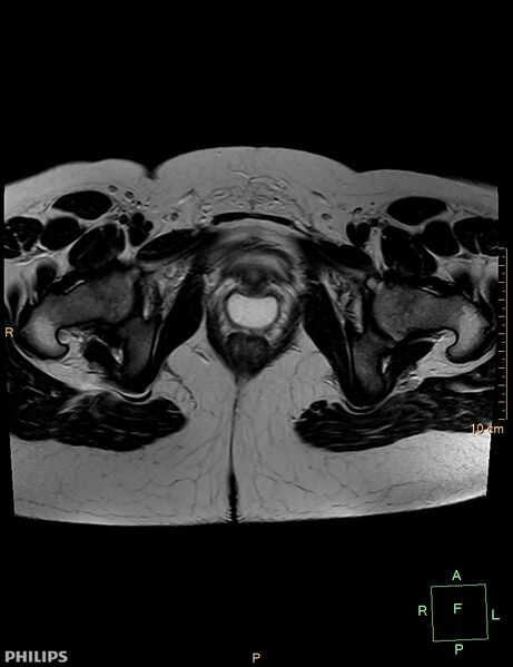 File:Cesarian scar endometriosis (Radiopaedia 68495-78066 Axial T2 22).jpg