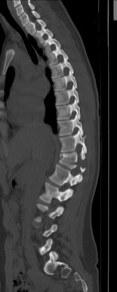 File:Chance fracture (Radiopaedia 45345-49372 Sagittal bone window 7).jpg