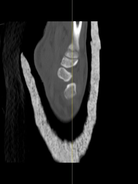 File:Chauffeur's (Hutchinson) fracture (Radiopaedia 58043-65079 Sagittal bone window 16).jpg