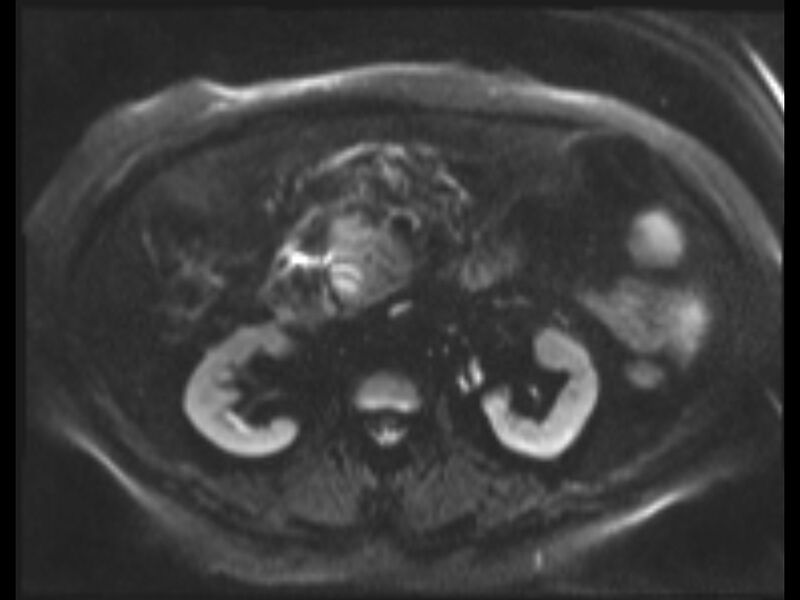 File:Choledocholithiasis causing intrahepatic biliary duct dilation (Radiopaedia 39908-42369 Axial T2 SPAIR 33).jpg