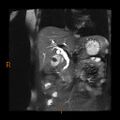 Cholelithiasis with biliary dilatation (Radiopaedia 49442-54589 Coronal T2 8).jpg