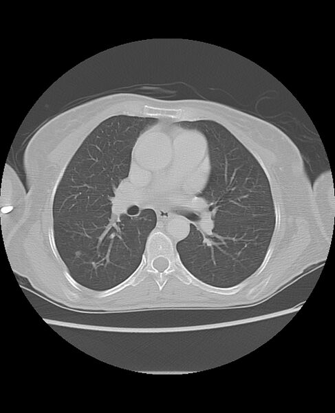 File:Chondrosarcoma (Radiopaedia 79427-92532 Axial lung window 27).jpg
