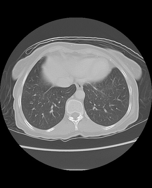 File:Chondrosarcoma (Radiopaedia 79427-92532 Axial lung window 45).jpg