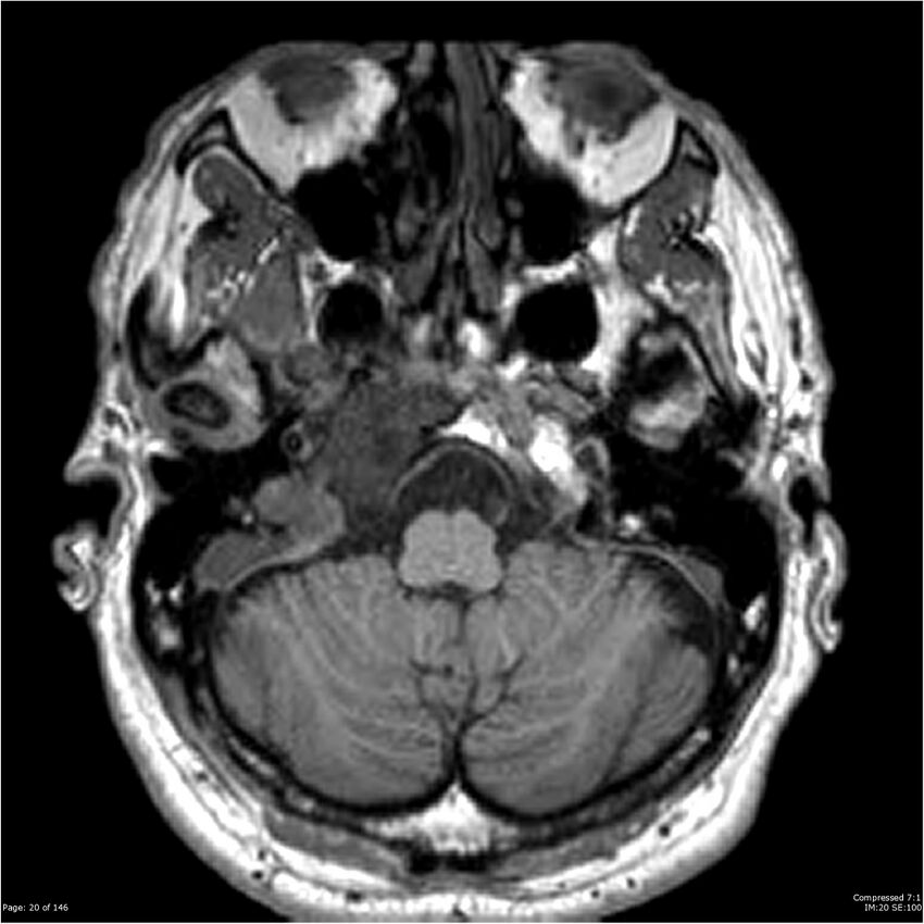 Chondrosarcoma of skull base- grade II (Radiopaedia 40948-43654 Axial T1 20).jpg