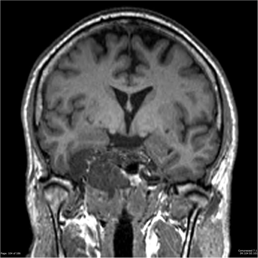 Chondrosarcoma of skull base- grade II (Radiopaedia 40948-43654 Coronal T1 25).jpg