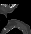 Chordoma (C4 vertebra) (Radiopaedia 47561-52188 Sagittal bone window 1).png