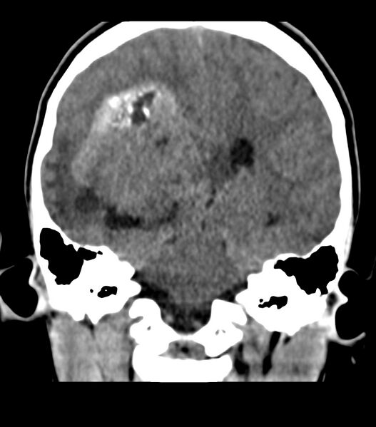 File:Choroid plexus carcinoma (Radiopaedia 91013-108552 Coronal non-contrast 53).jpg