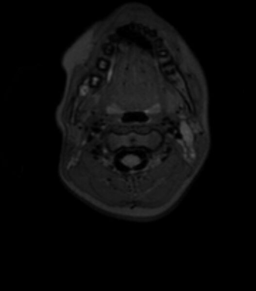 File:Choroid plexus carcinoma (Radiopaedia 91013-108553 Axial T2 fat sat 1).jpg