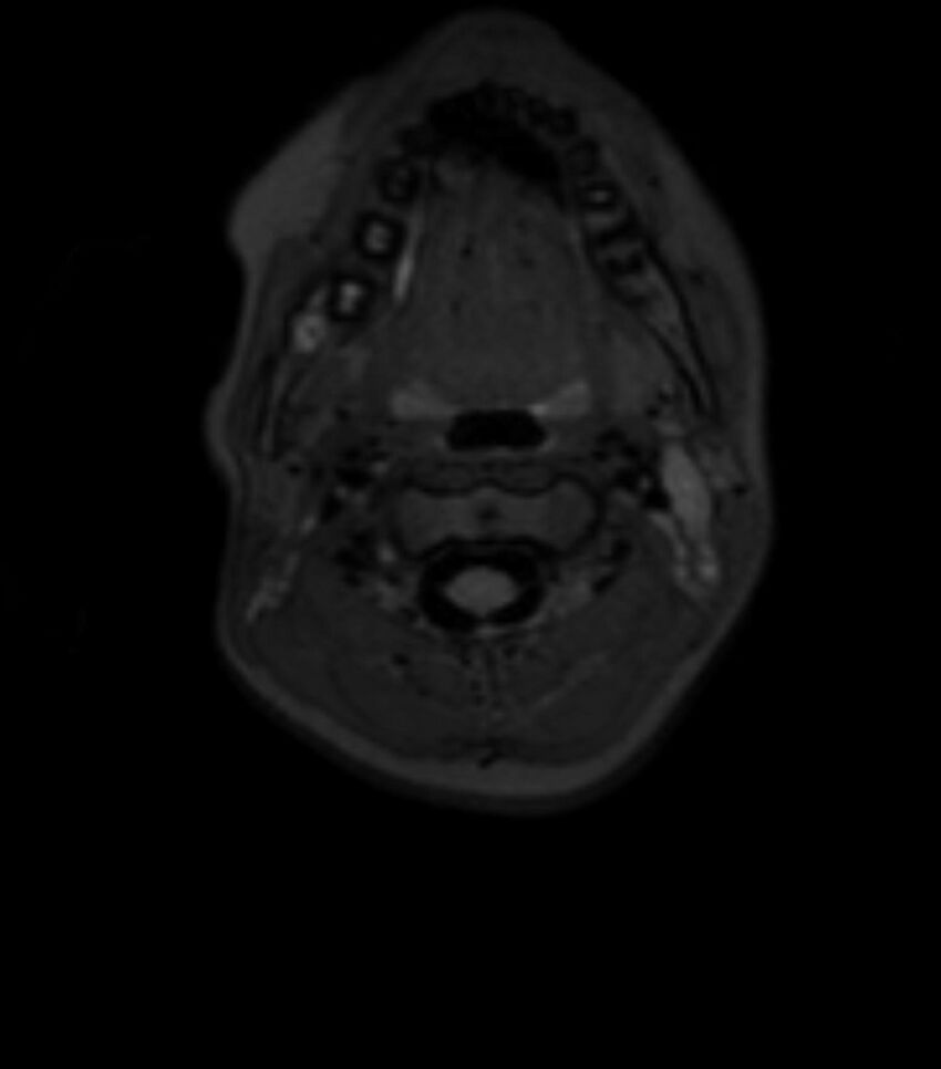 Choroid plexus carcinoma (Radiopaedia 91013-108553 Axial T2 fat sat 1).jpg