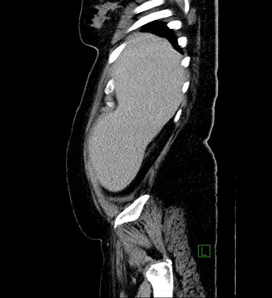 File:Chromophobe renal cell carcinoma (Radiopaedia 84239-99519 G 101).jpg