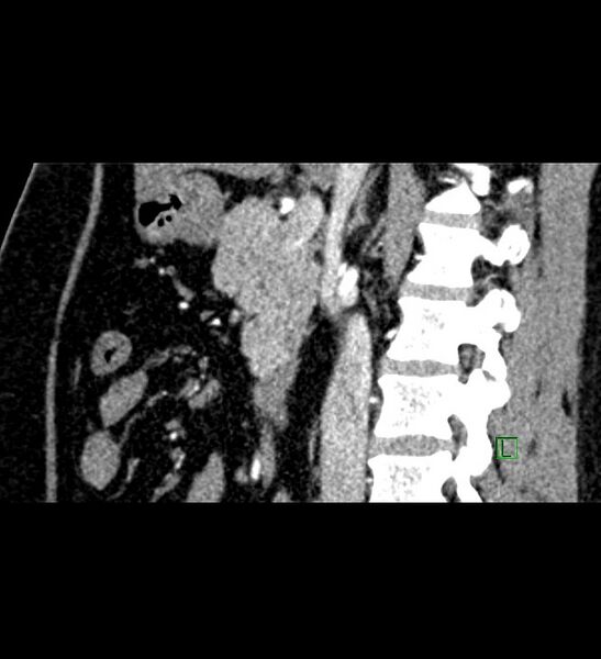File:Chromophobe renal cell carcinoma (Radiopaedia 84286-99573 F 94).jpg