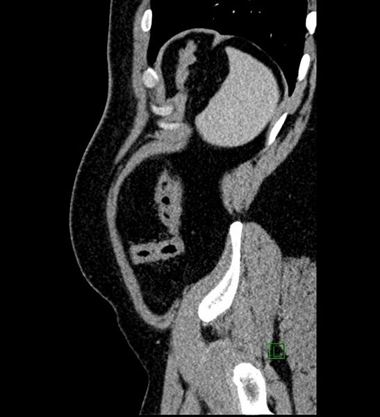File:Chromophobe renal cell carcinoma (Radiopaedia 84286-99573 I 19).jpg