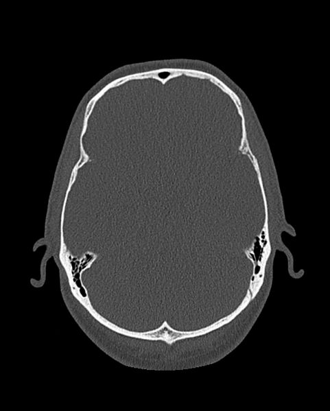 File:Chronic maxillary sinusitis caused by a foreign body (Radiopaedia 58521-65676 Axial bone window 304).jpg