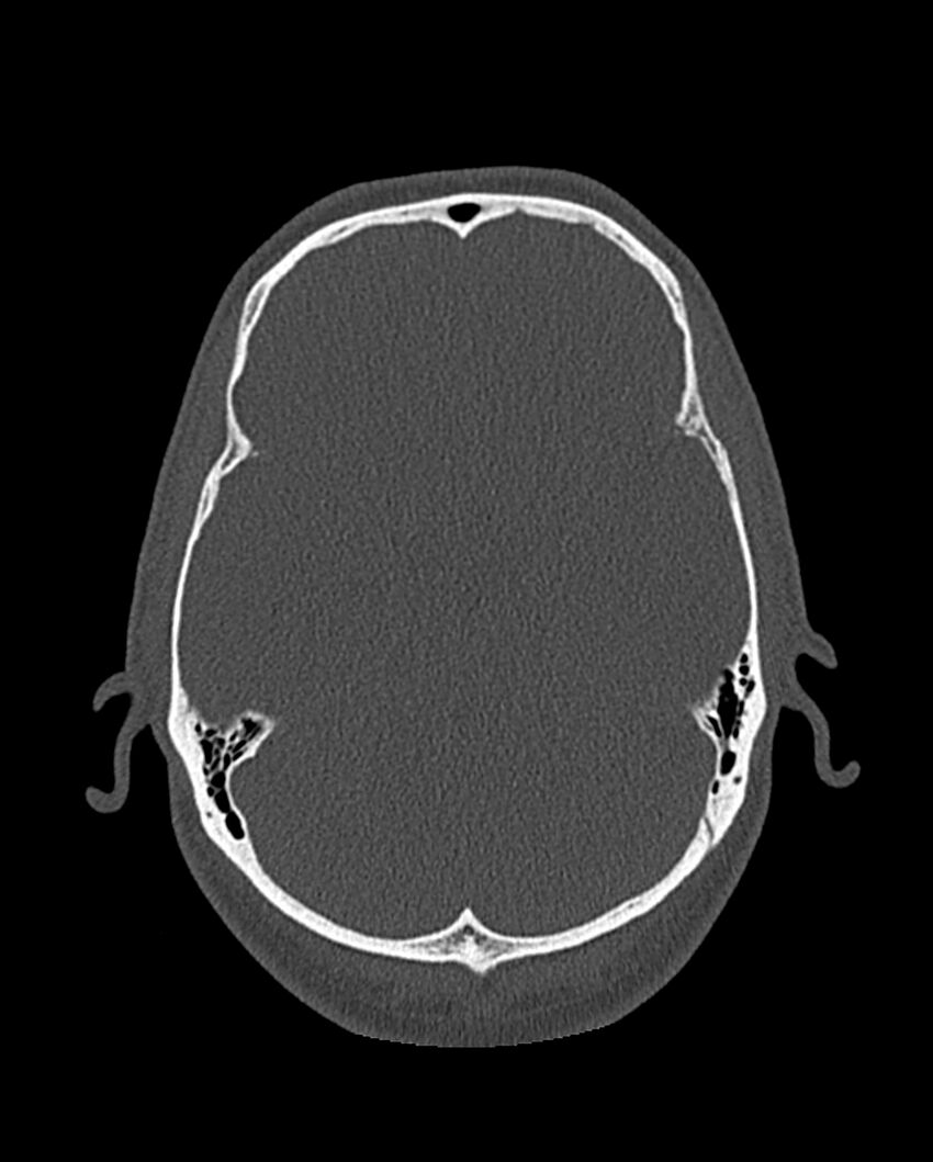 Chronic maxillary sinusitis caused by a foreign body (Radiopaedia 58521-65676 Axial bone window 304).jpg