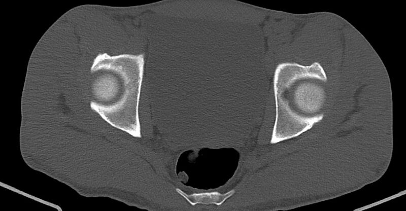 File:Chronic osteomyelitis (with sequestrum) (Radiopaedia 74813-85822 Axial non-contrast 31).jpg