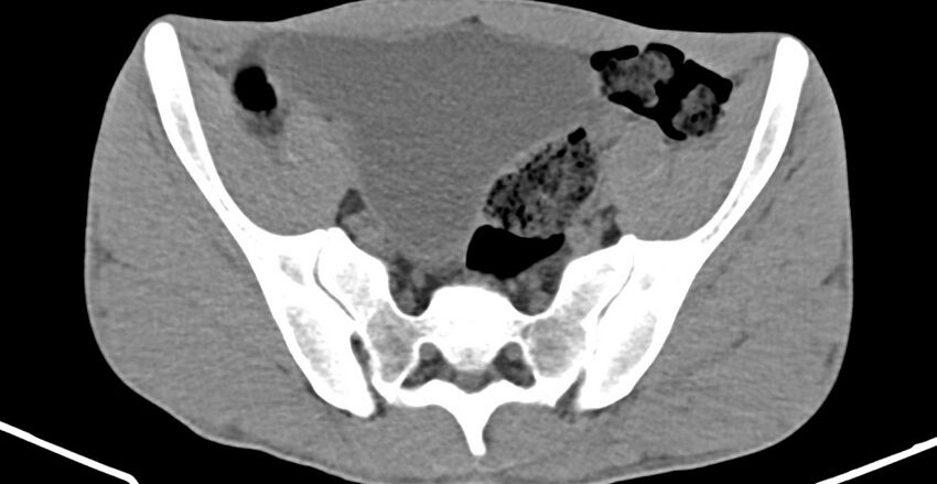 Chronic osteomyelitis (with sequestrum) (Radiopaedia 74813-85822 D 11).jpg