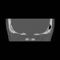 Chronic otomastoiditis (Radiopaedia 27138-27309 Coronal bone window 26).jpg