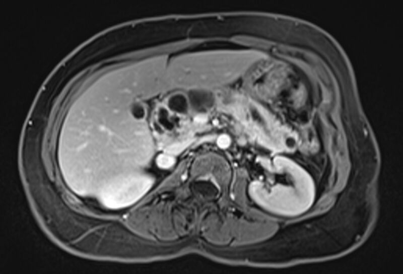 File:Chronic pancreatitis - pancreatic duct calculi (Radiopaedia 71818-82250 Axial T1 C+ fat sat 29).jpg
