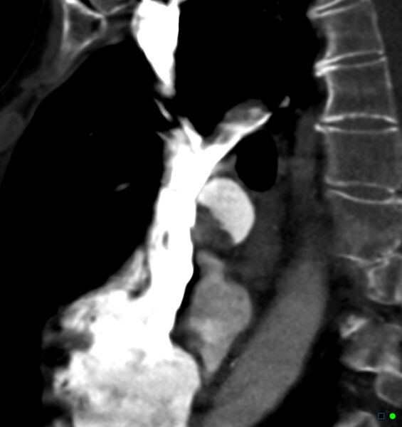 File:Chronic pulmonary embolism (Radiopaedia 17943-17702 Sagittal C+ CTPA 22).jpg