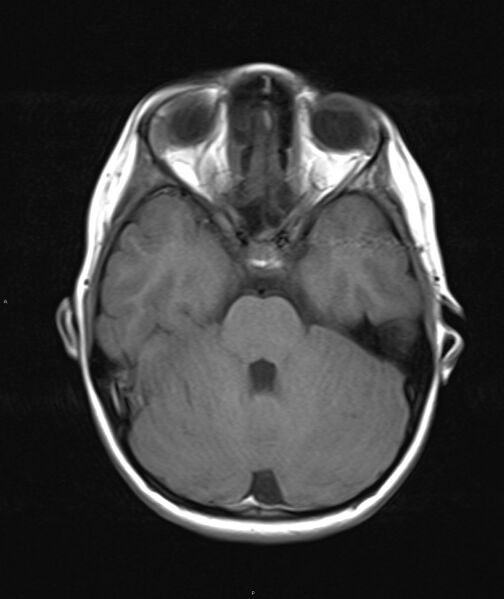File:Chronic reactive multifocal osteomyelitis (CRMO) - mandible (Radiopaedia 56405-63069 Axial T1 26).jpg