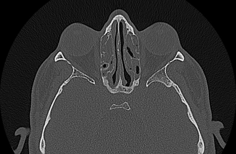 File:Chronic rhinosinusitis (Radiopaedia 65079-74075 Axial bone window 52).jpg