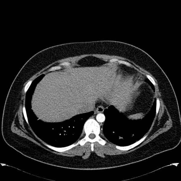 File:Chronic thromboembolic pulmonary hypertension (CTEPH) (Radiopaedia 74597-85531 Axial C+ CTPA 42).jpg