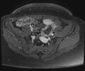 Class II Mullerian duct anomaly- unicornuate uterus with rudimentary horn and non-communicating cavity (Radiopaedia 39441-41755 Axial T1 fat sat 18).jpg
