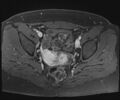 Class II Mullerian duct anomaly- unicornuate uterus with rudimentary horn and non-communicating cavity (Radiopaedia 39441-41755 Axial T1 fat sat 71).jpg