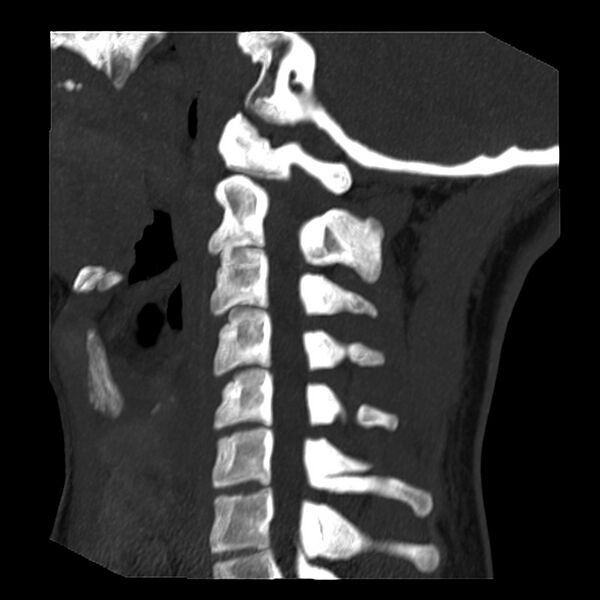 File:Clay-shoveler fracture (Radiopaedia 22568-22590 Sagittal MIP 7).jpg