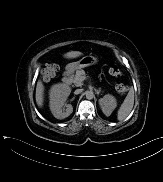 File:Clear cell renal cell carcinoma (Radiopaedia 85004-100537 Axial non-contrast 5).jpg