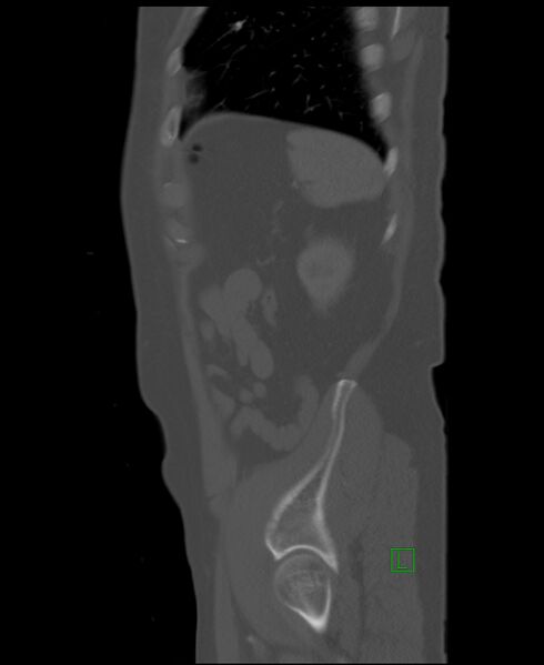 File:Clear cell renal cell carcinoma (Radiopaedia 85006-100539 Sagittal bone window 10).jpg