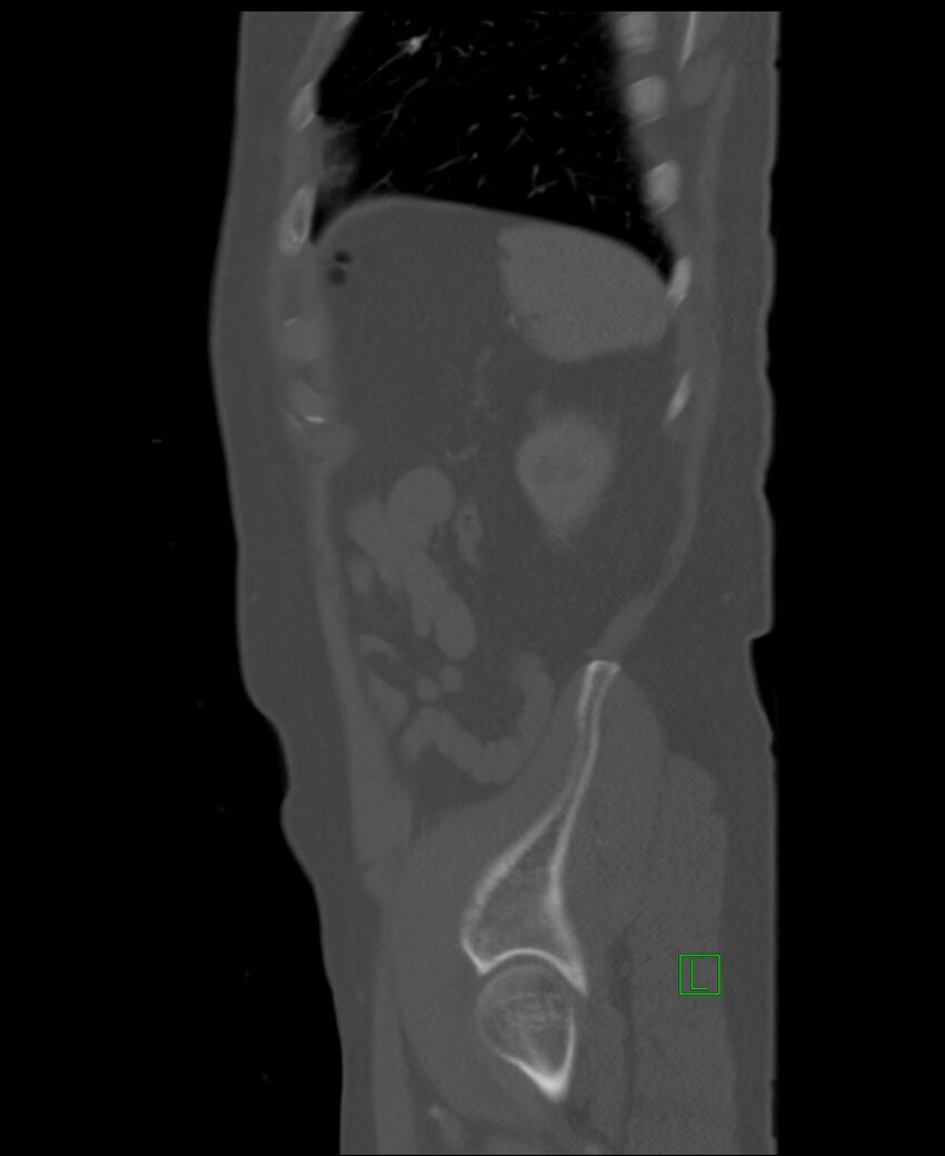 Clear cell renal cell carcinoma (Radiopaedia 85006-100539 Sagittal bone window 10).jpg