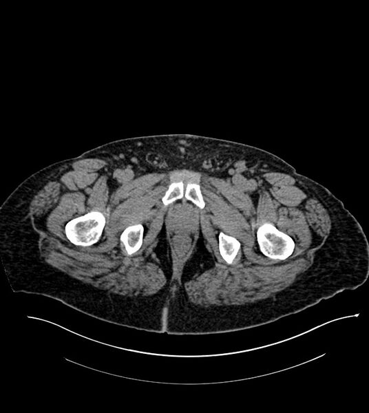 File:Closed-loop small bowel obstruction-internal hernia (Radiopaedia 78439-91096 Axial non-contrast 159).jpg