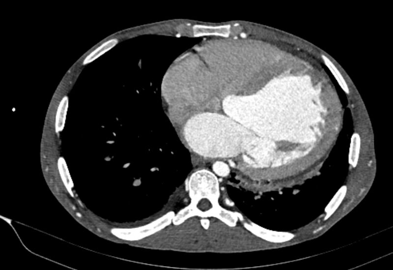 File:Coarctation of aorta with aortic valve stenosis (Radiopaedia 70463-80574 A 145).jpg