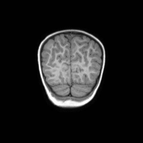 File:Cochlear nerve aplasia - unilateral (Radiopaedia 87910-104413 Coronal T1 46).jpg