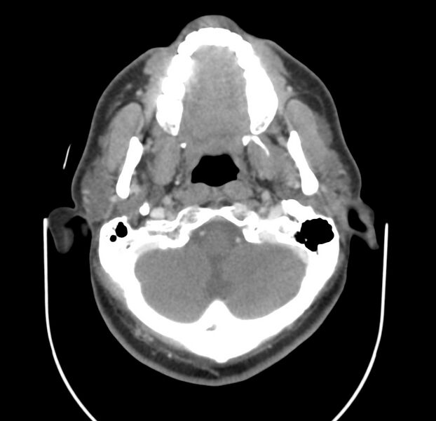 File:Colloid cyst of thyroid (Radiopaedia 22897-22923 Axial C+ delayed 17).jpg