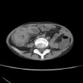 Colocolic fistula - Crohn disease (Radiopaedia 57063-63955 A 51).jpg