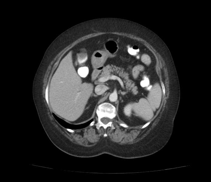 File:Colonic diverticulosis (Radiopaedia 22934-22957 A 22).jpg