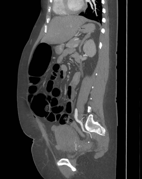 File:Colonic pseudo-obstruction (Radiopaedia 79752-92980 C 47).png