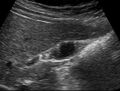 Gallbladder adenomyomatosis (Radiopaedia 10535).jpg