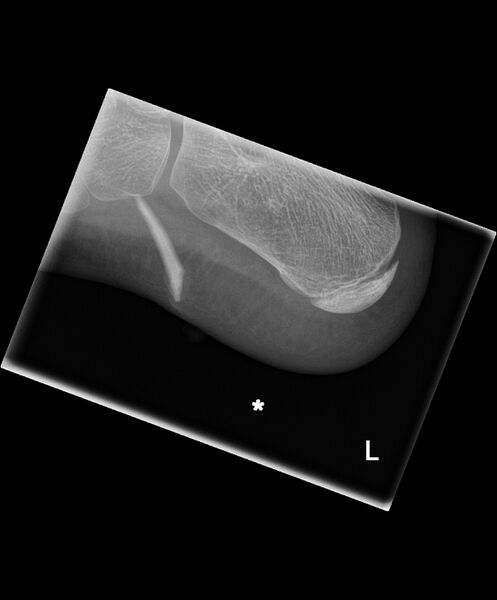 File:Glass foreign body in foot (Radiopaedia 66209).jpg